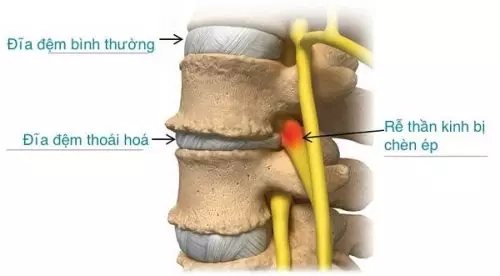 Thoái hóa mất nước đĩa đệm là gì?